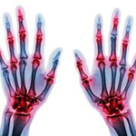 603-arthritis